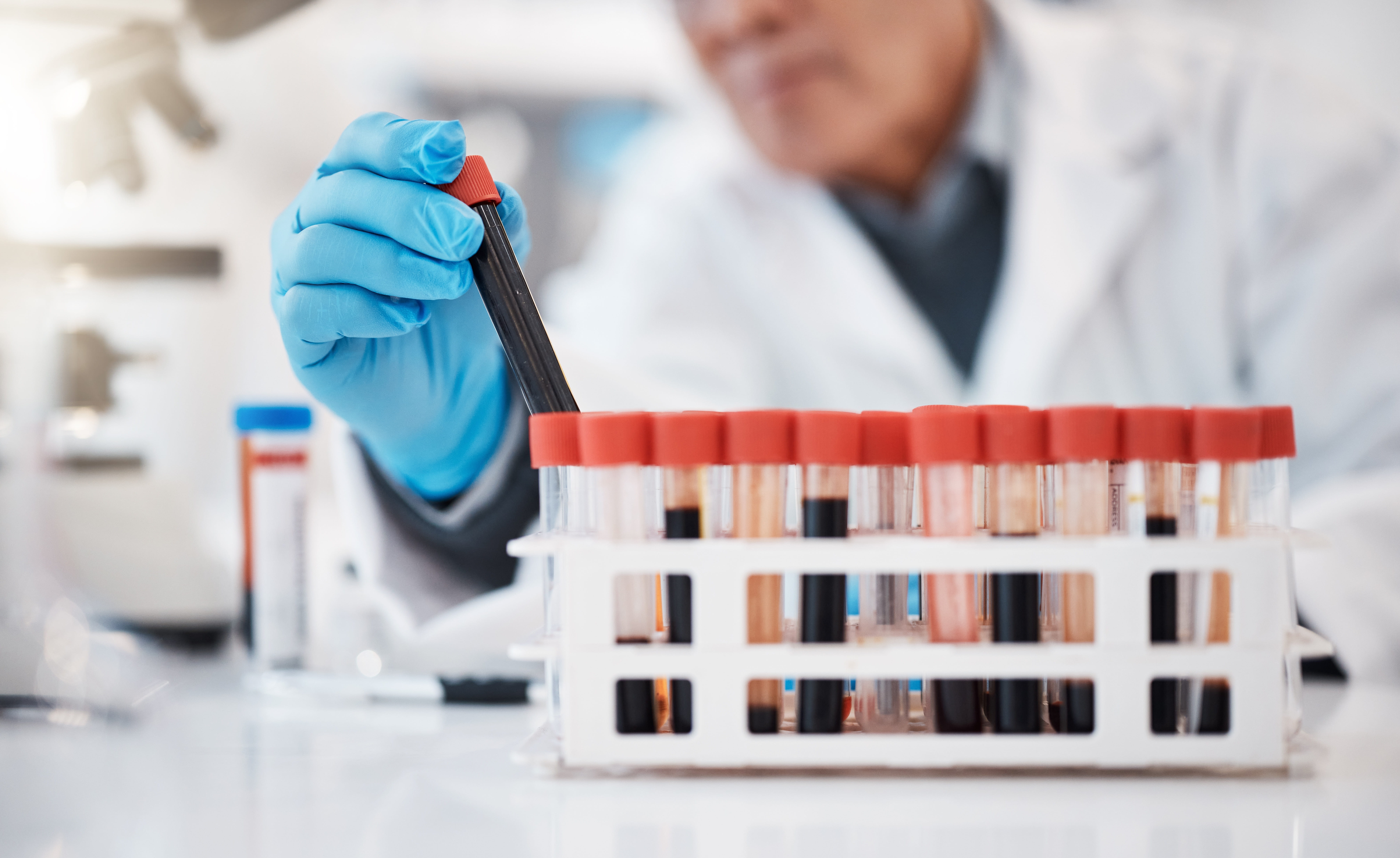 Researchers Identify a Promising Blood Test for Detecting Alzheimer’s Risk